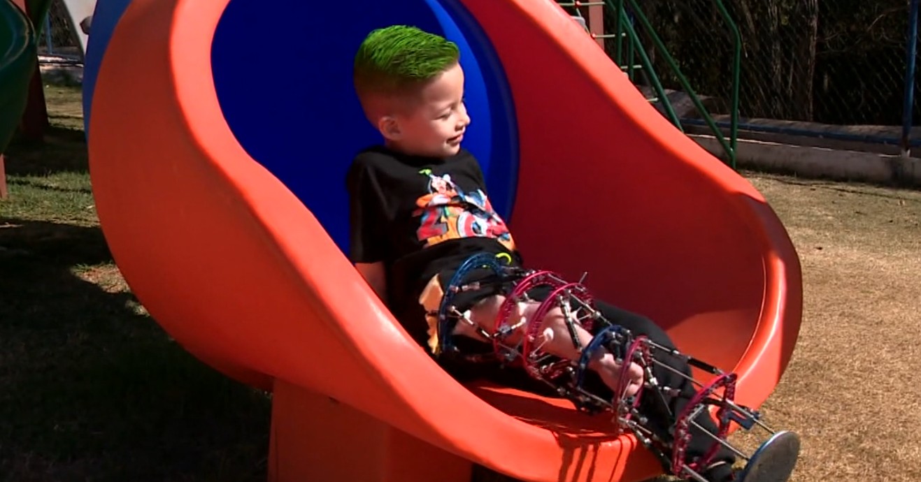 'Sou um super-herói': com doença rara, menino de 6 anos usa bom humor para lidar com cirurgias e tratamento para alongar perna