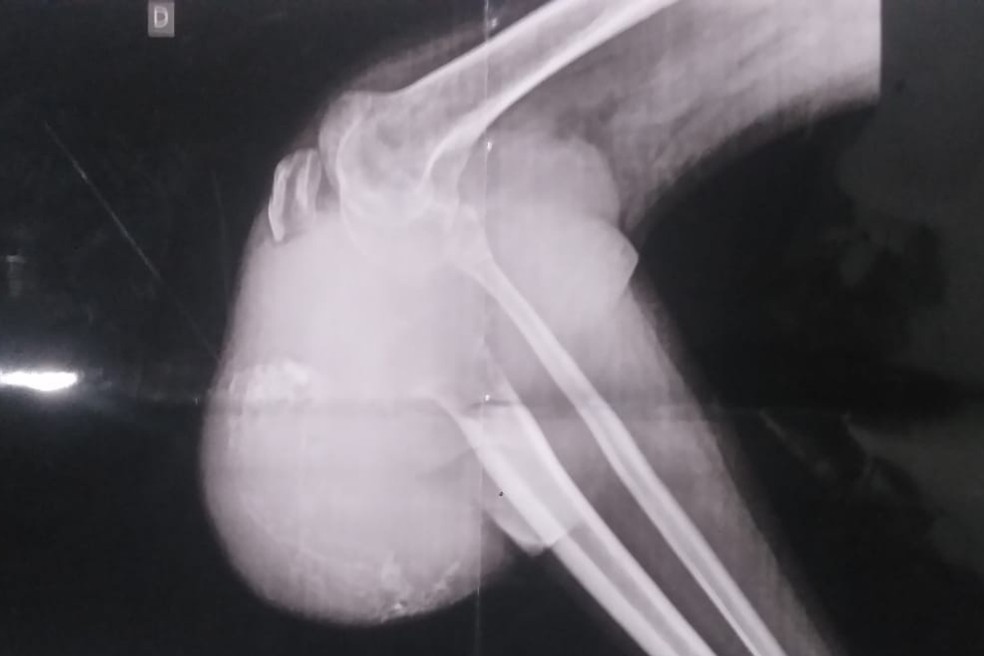 Exame mostra a situação do tumor ósseo na perna do morador de Praia Grande (SP), que luta por cirurgia — Foto: Arquivo Pessoal