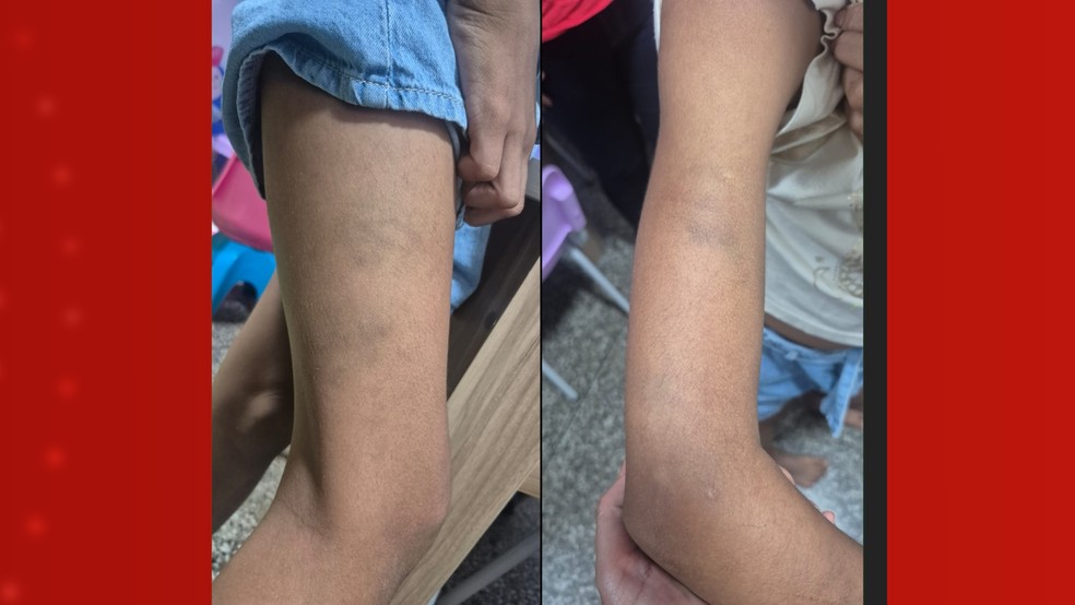 Durante a troca de roupas, foram identificadas diversas marcas de agressão em uma das crianças resgatadas em situação de abandono em Manaus — Foto: Reprodução/Rede Amazônica