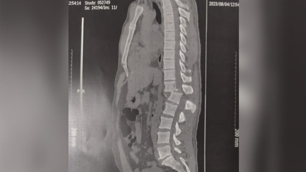 Raio-x mostra lesão na coluna de jovem lesão de jovem atingido por aparelho em academia de ginástica no Ceará — Foto: Arquivo pessoal/Reprodução