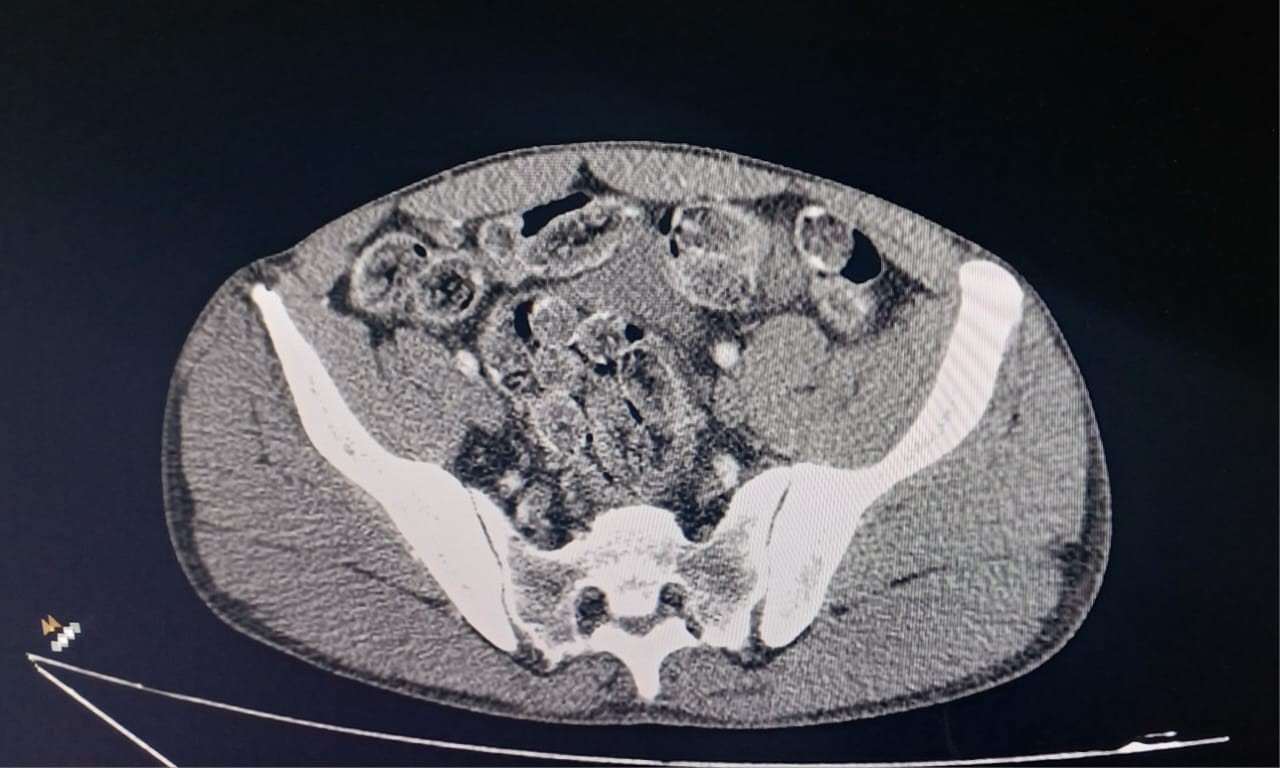Bolivianos são presos com cápsulas de cocaína no estômago após abordagem na Rodovia Castello Branco em Itu