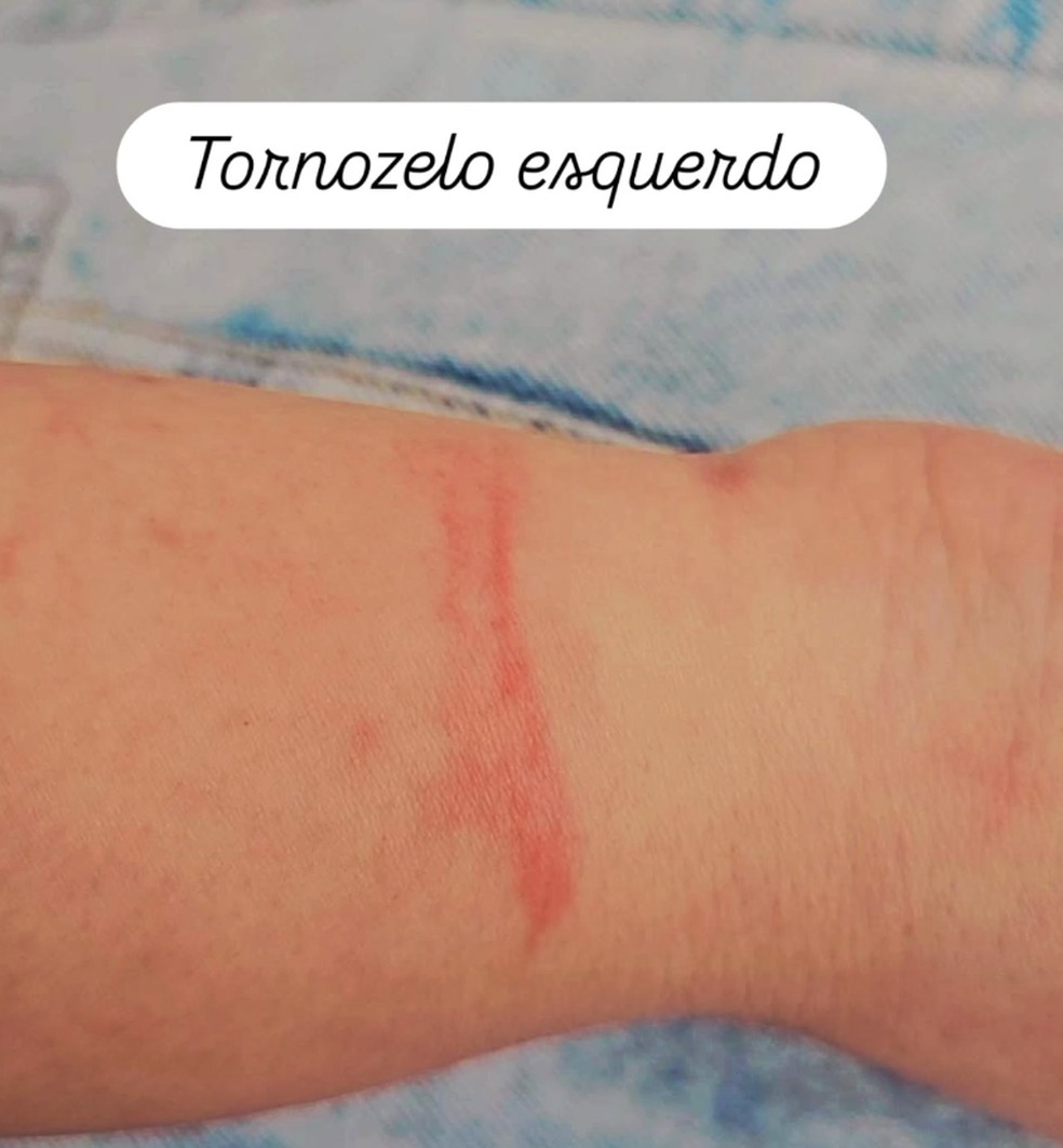 Advogada brasileira mostra hematomas no tornozelo após afirmar ter sido agredido pela polícia no aeroporto de Porto — Foto: Instagram/Reprodução