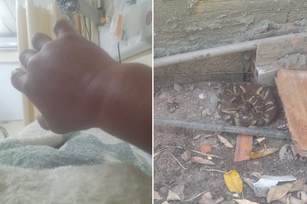 Mão de artesão ficou inchada após ser mordido por jararaca em Guarujá (SP) — Foto: Arquivo Pessoal