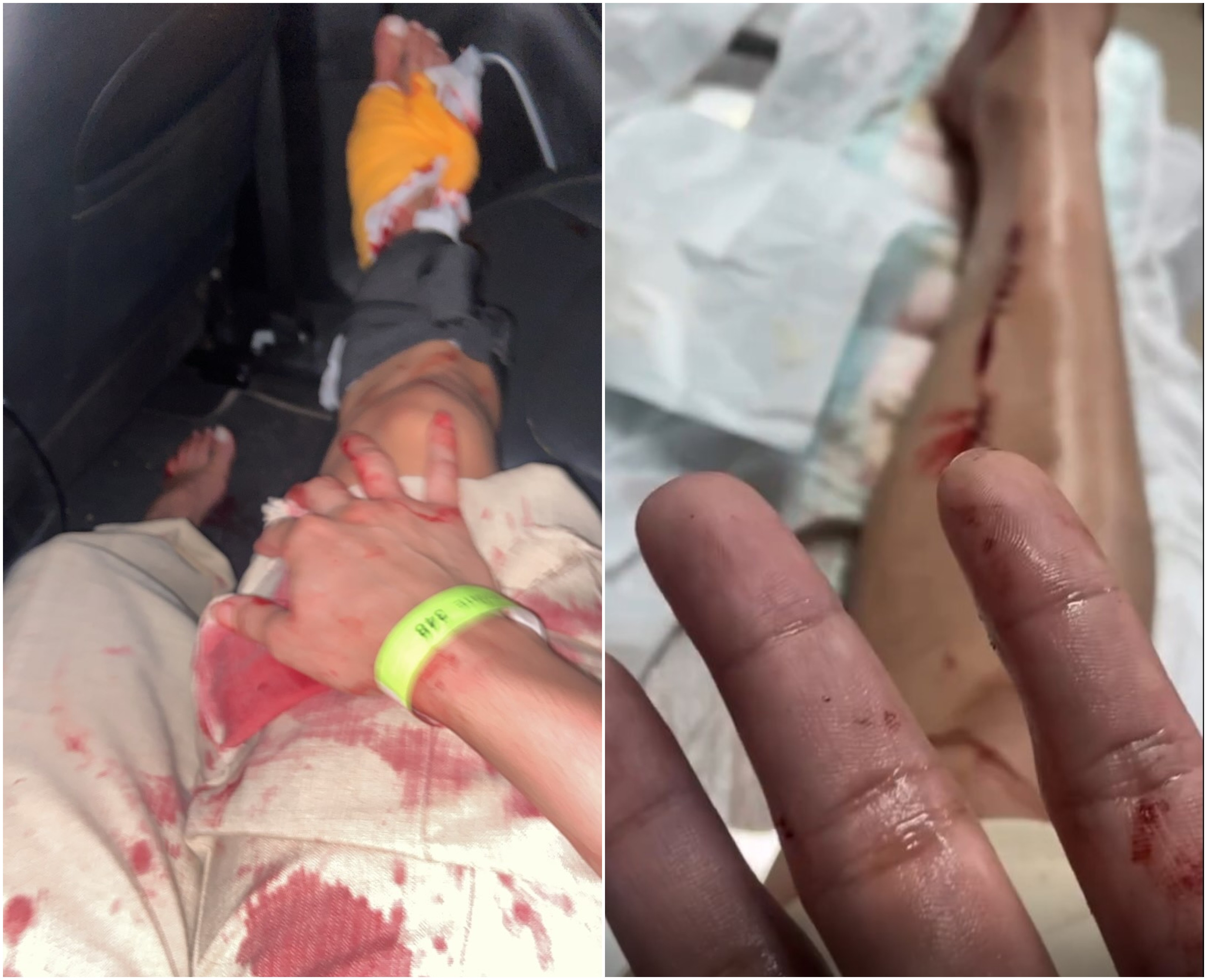 Mulher trans é agredida por homem com garrafas em festa na zona Leste de Boa Vista