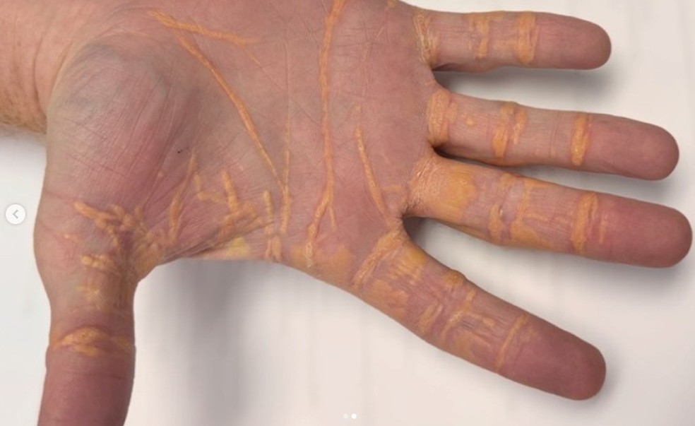 Homem estava com índices tão altos de colesterol, que viu nódulos nascerem nas mãos — Foto: Divulgação/JAMA