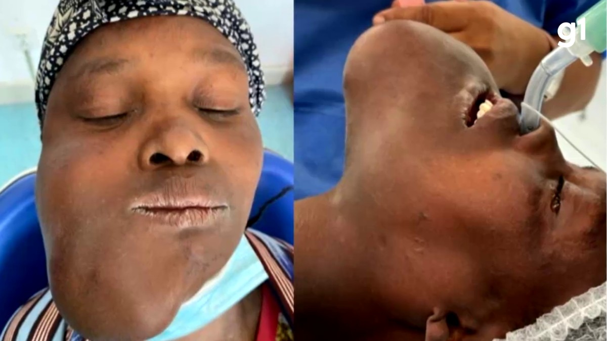 Mulher espera um ano por cirurgia e vira símbolo de missão humanitária de médicos do RS em Angola