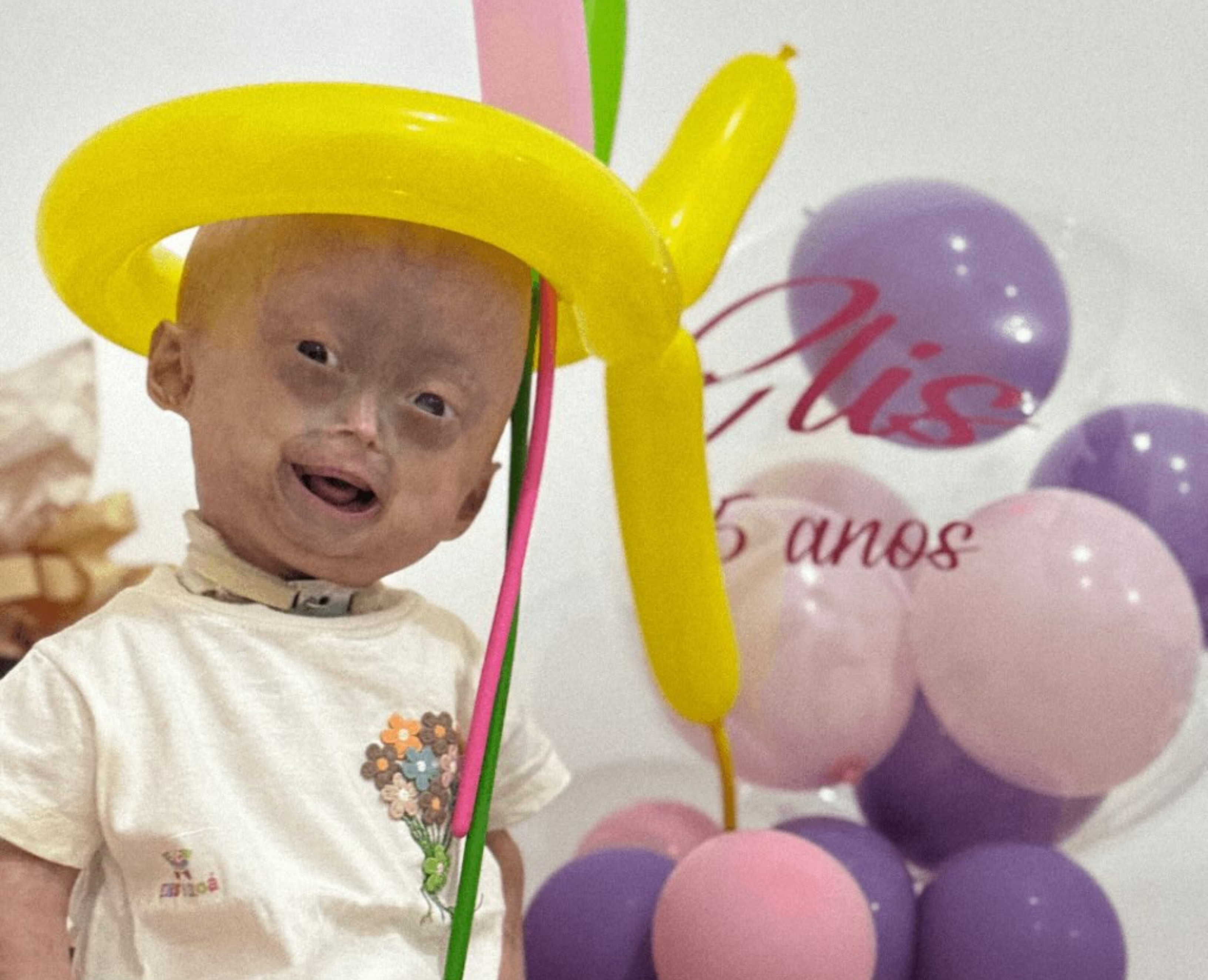Morre gêmea diagnosticada com síndrome rara da velhice precoce em Roraima