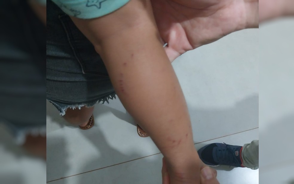 Ferimento na perna do menino que foi atacado por sucuri em Goiás — Foto: Divulgação/PMGO