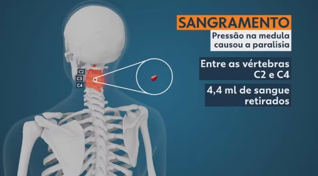 Hematoma epidural cervical espontâneo: entenda condição que fez jovem perder movimentos do corpo após dor na nuca