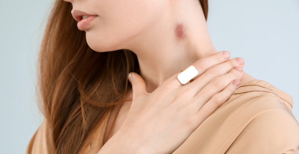 Mulher tem AVC após chupão no pescoço — Foto: Adobe Stock
