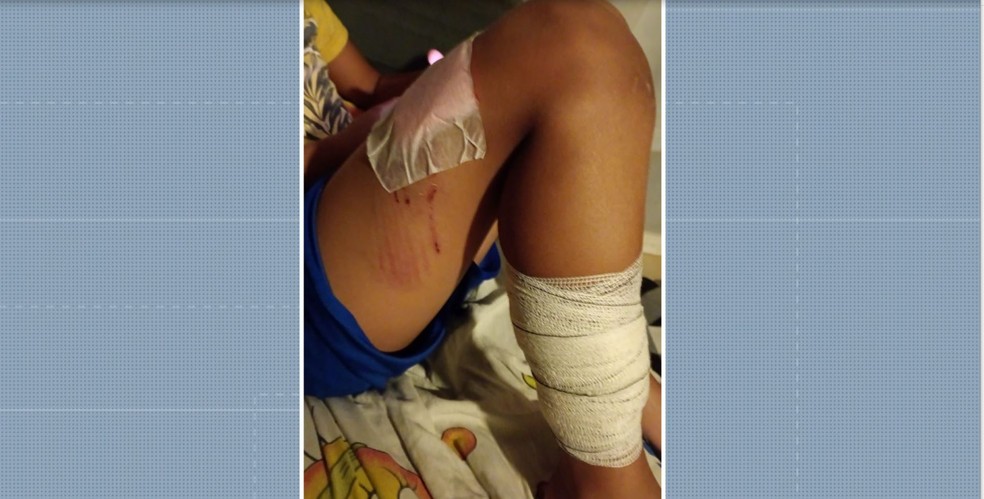 Criança foi atacada por cão da raça pitbull em Monte Mor — Foto: Reprodução/EPTV