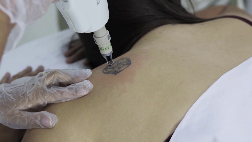 Foto de arquivo: Tecnologias permitem a remoção de tatuagem — Foto: OligoFlora/Divulgação