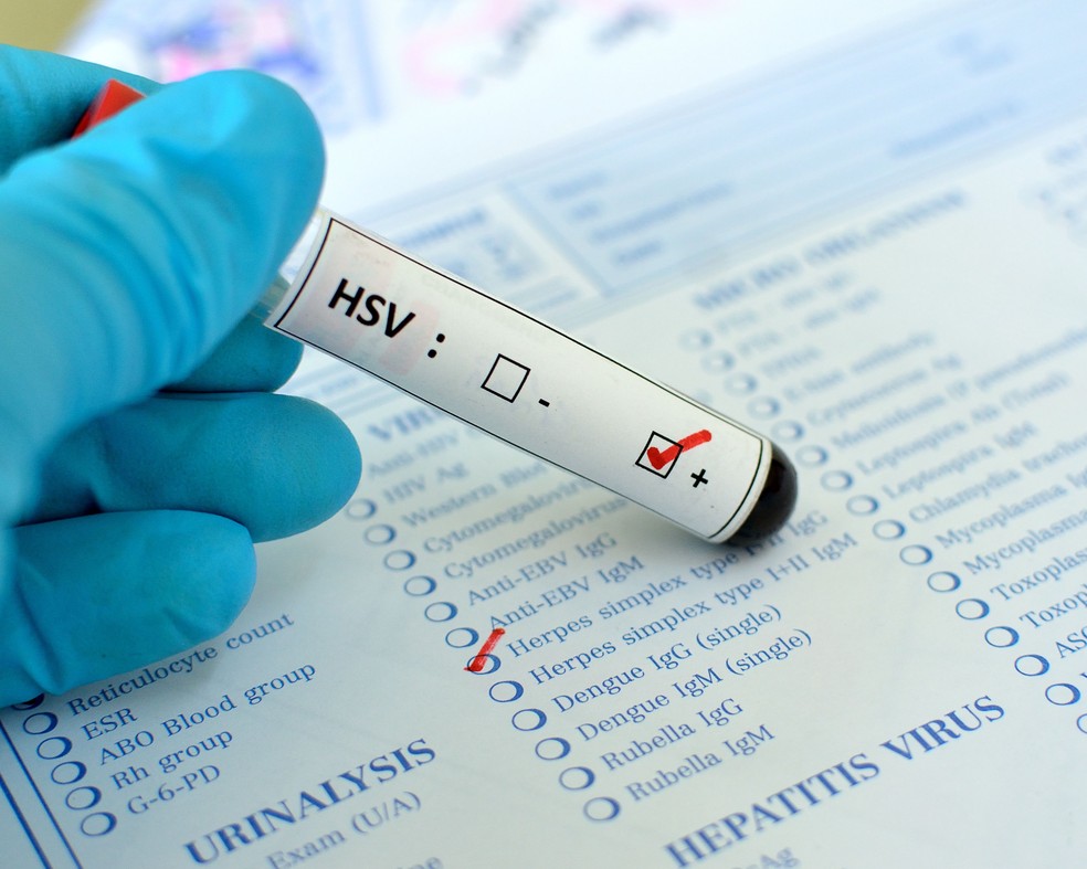 O que se sabe sobre a herpes genital — Foto: Reprodução/Canva Pro