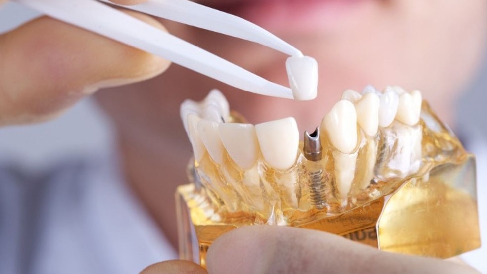 Feitos de titânio e porcelana, os implantes dentários são uma forma segura e duradoura para a reabilitação bucal  — Foto: Arquivo (imagem ilustrativa)