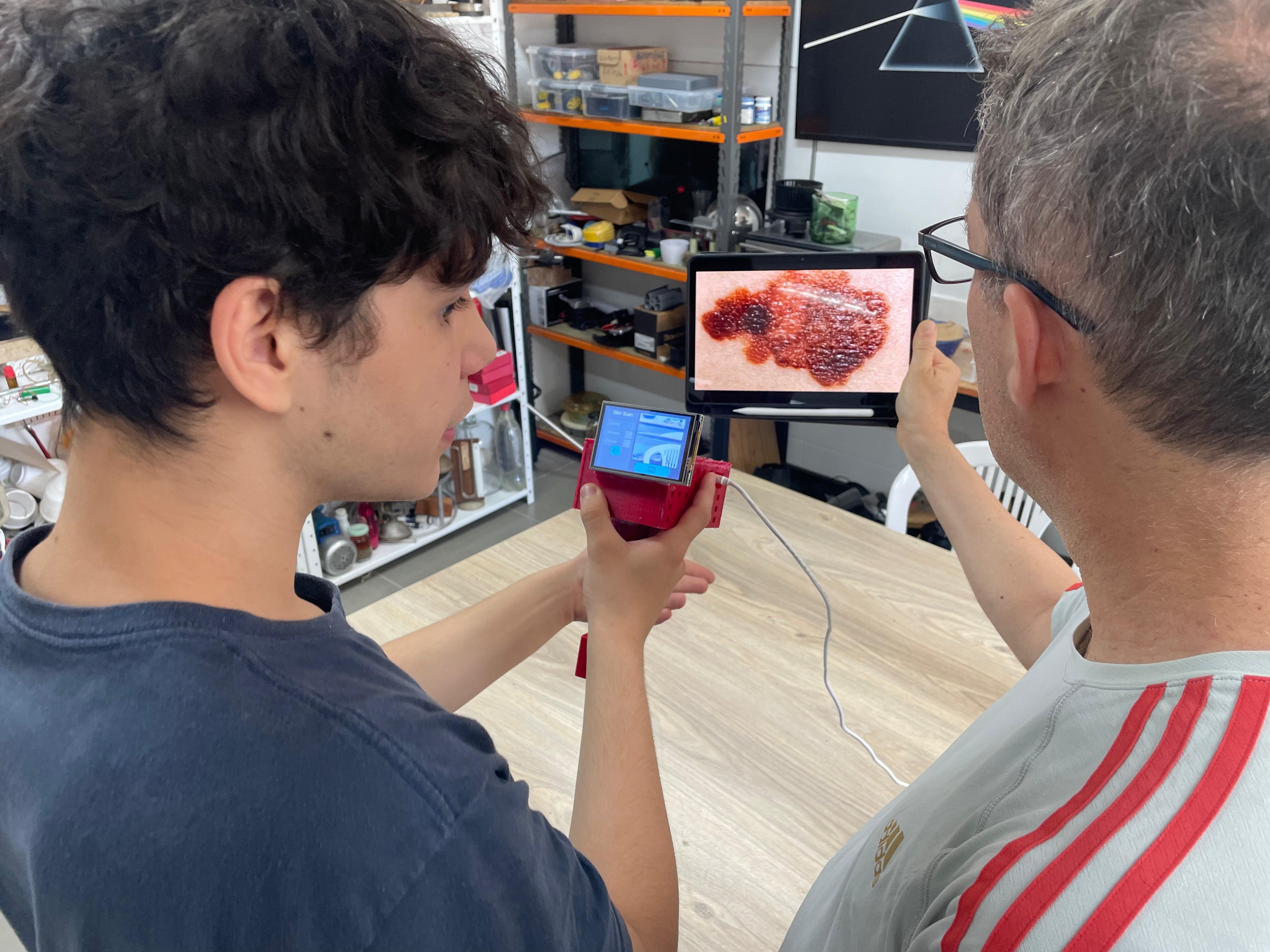 Estudantes do RS criam dispositivo portátil com IA para detectar câncer de pele
