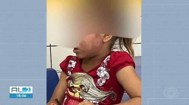 Pai é preso em Taquarana após agredir filha de 6 anos com marca de agressão de sandália no rosto