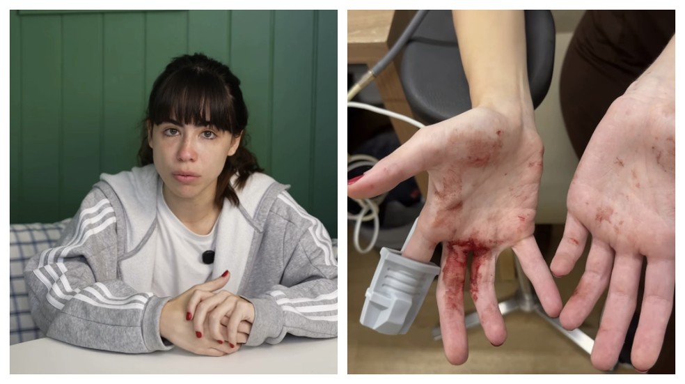 Nina contou que teve uma reação instintiva e chegou a correr atrás dos assaltantes, gritando por ajuda no meio da rua, com as mãos e os braços ensanguentados. — Foto: Reprodução / Instagram