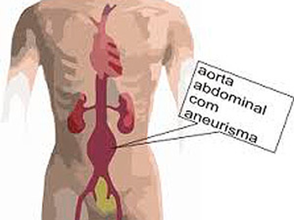 O aneurisma da aorta raramente apresenta sintomas. Caracteriza-se por um enfraquecimento em determinado ponto da parede arterial, na altura do abdome ou do tórax — Foto: Beth Nunes/Divulgação