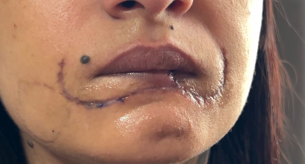Mulher perdeu metade dos lábios inferiores em General Salgado (SP) — Foto: Rogério Pedrozo/TV TEM