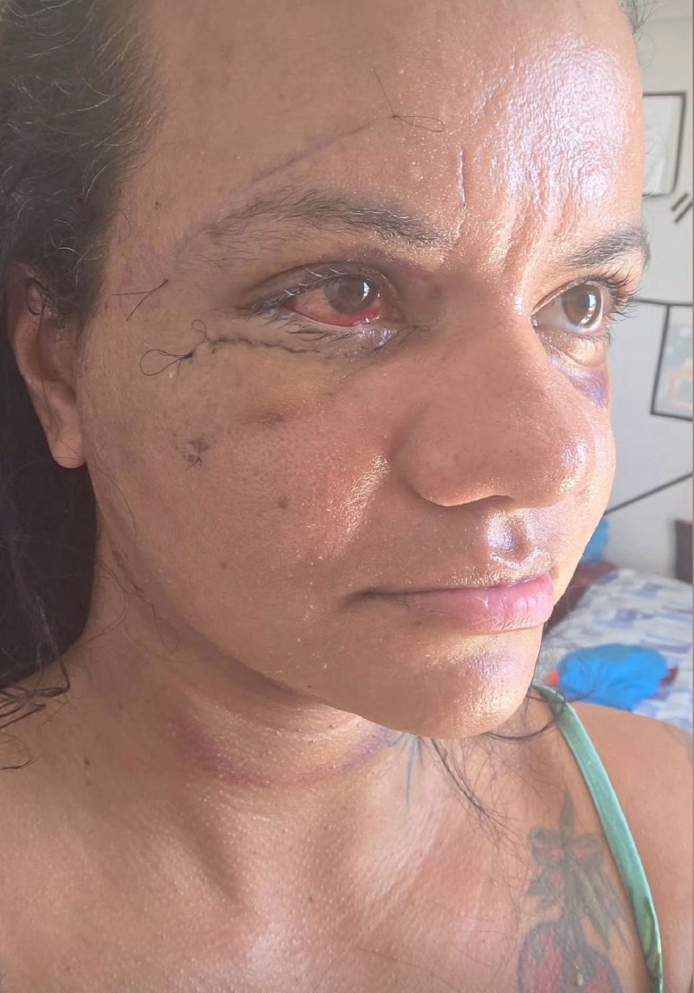 Juliana Soares, de 35 anos, após cirurgia para reconstrução do rosto — Foto: Cedida