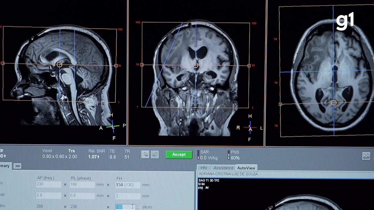 Tecnologia brasileira: entenda como ressonância magnética portátil vai usar IA para melhorar imagens e reduzir custos do SUS