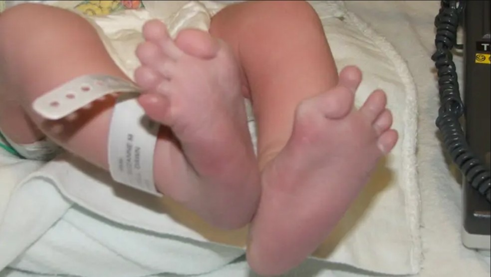 Imagem mostra pé com doença rara que transforma músculos em ossos — Foto: Reprodução/ Ifopa