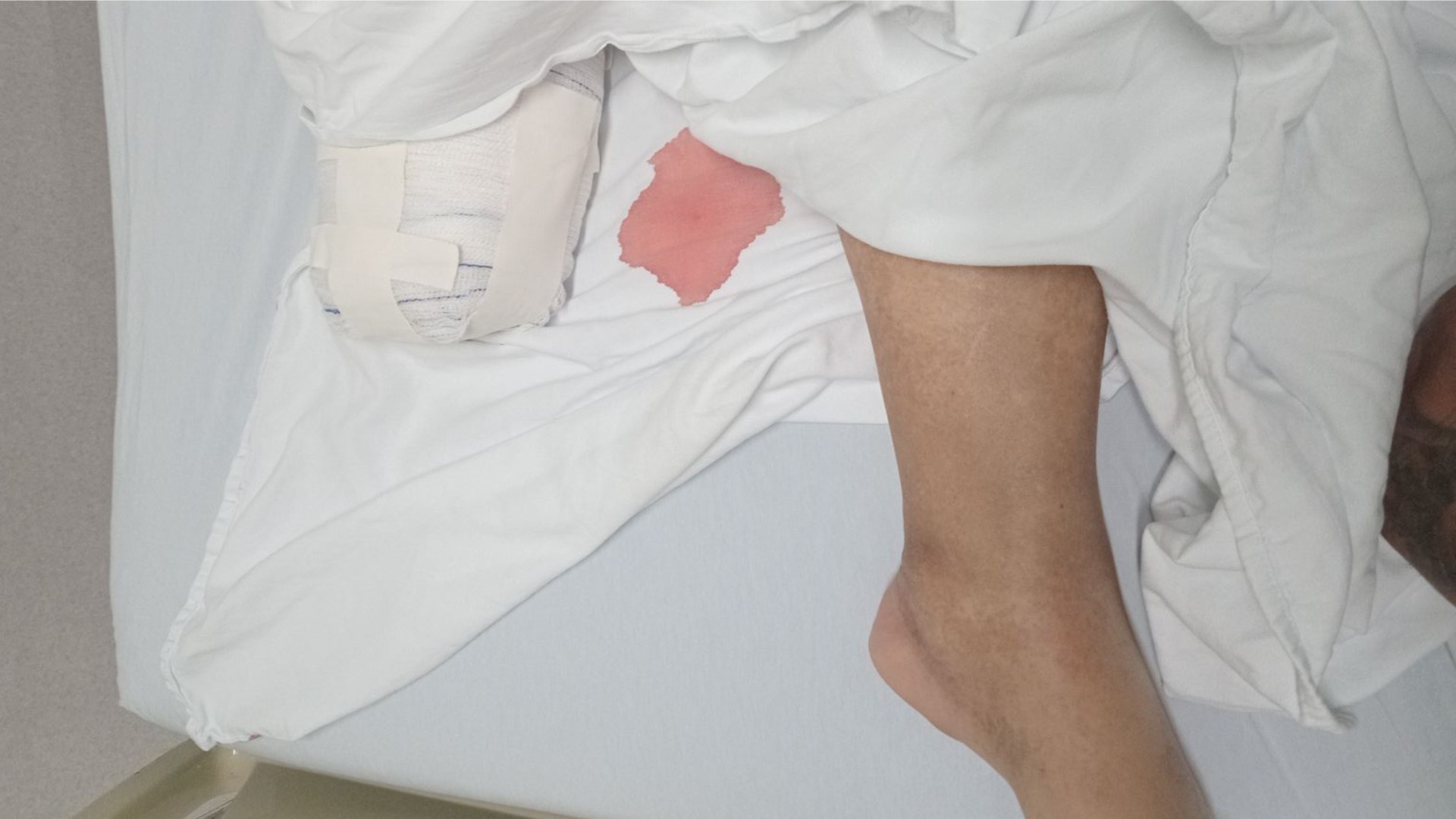 Aposentado pisa em brinco, tem infecção e precisa amputar o pé após aguardar por vaga em hospital