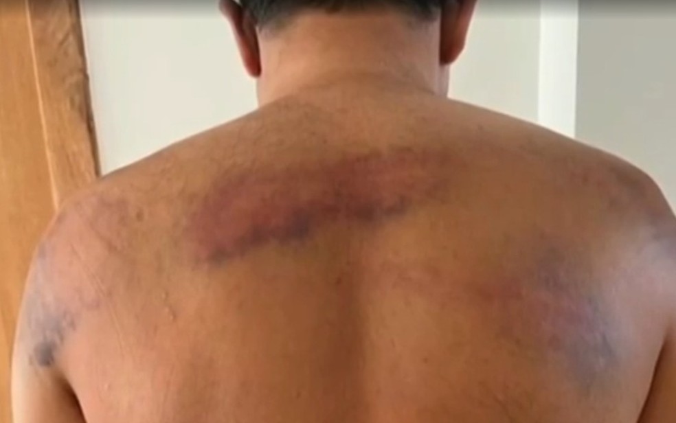 Marcas nas costas de uma das vítimas — Foto: Reprodução/TV Bahia
