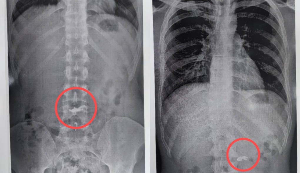 Homem é preso após furtar e engolir correntinha; radiografia mostra objeto no estômago     