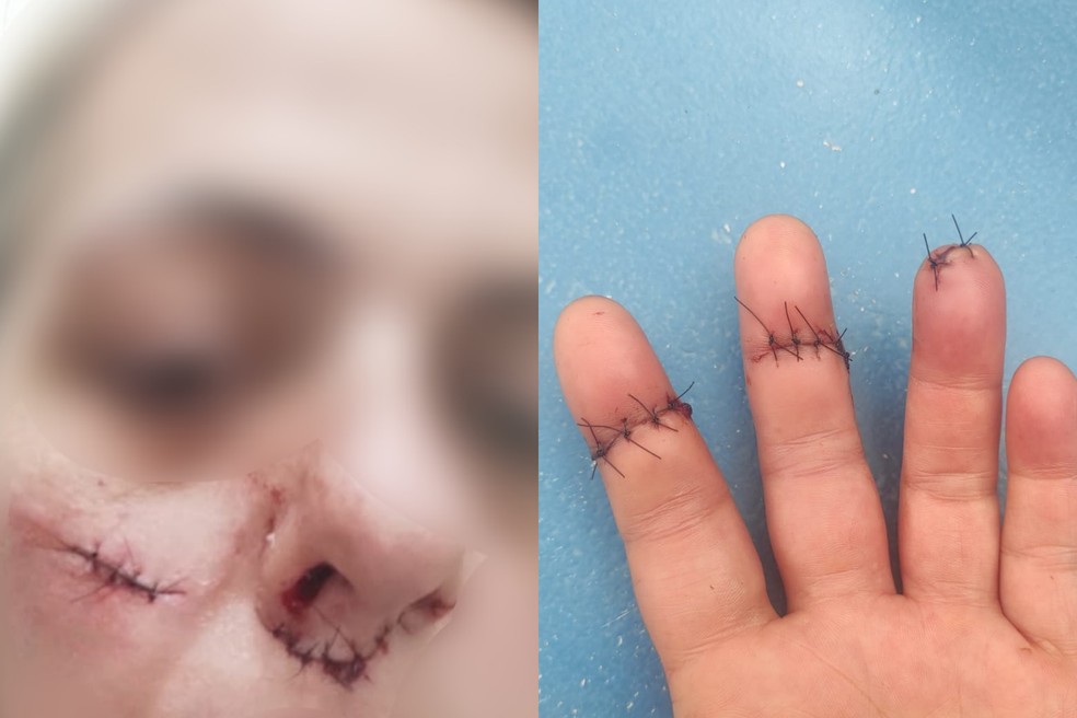 Cozinheira de 45 anos que teve o rosto e os tendões de dois dedos cortados por uma linha com cerol em Araçatuba (SP) — Foto: Arquivo pessoal