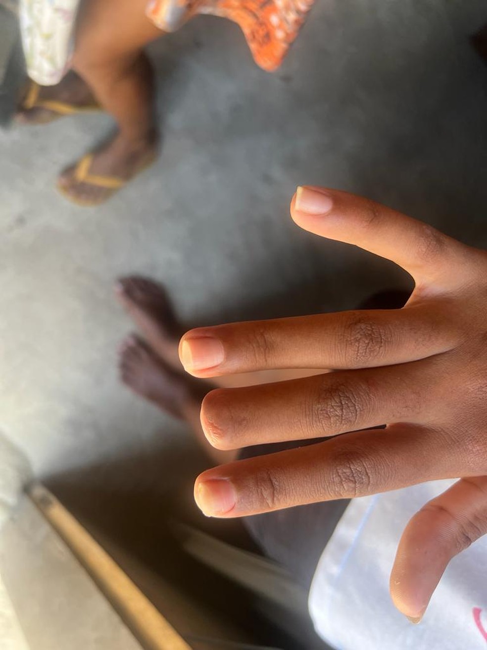 Adolescente perdeu parte de um dedo e voltou ao trabalho apenas dois dias depois, com sequelas — Foto: Reprodução/Arquivo Pessoal
