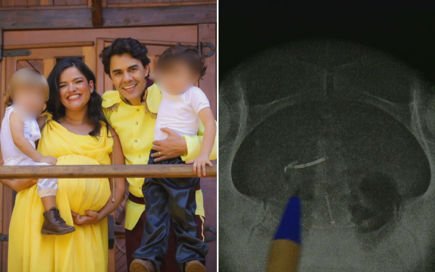 Mãe encontra DIU na barriga anos depois de ter engravidado usando o anticoncepcional; vídeo