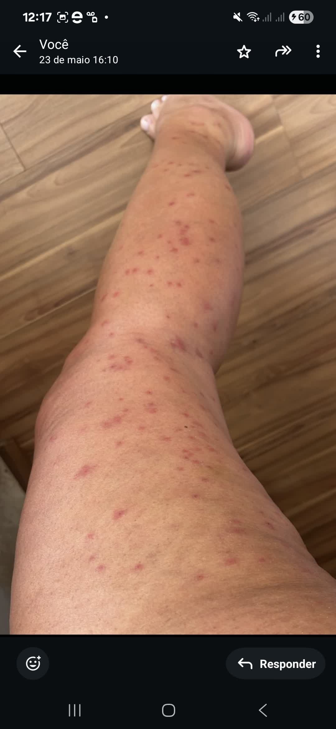 Surto de mosquitos borrachudos muda rotina de moradores de bairros do Rio e gera alergias e feridas: ‘Nem roupa grossa adianta’