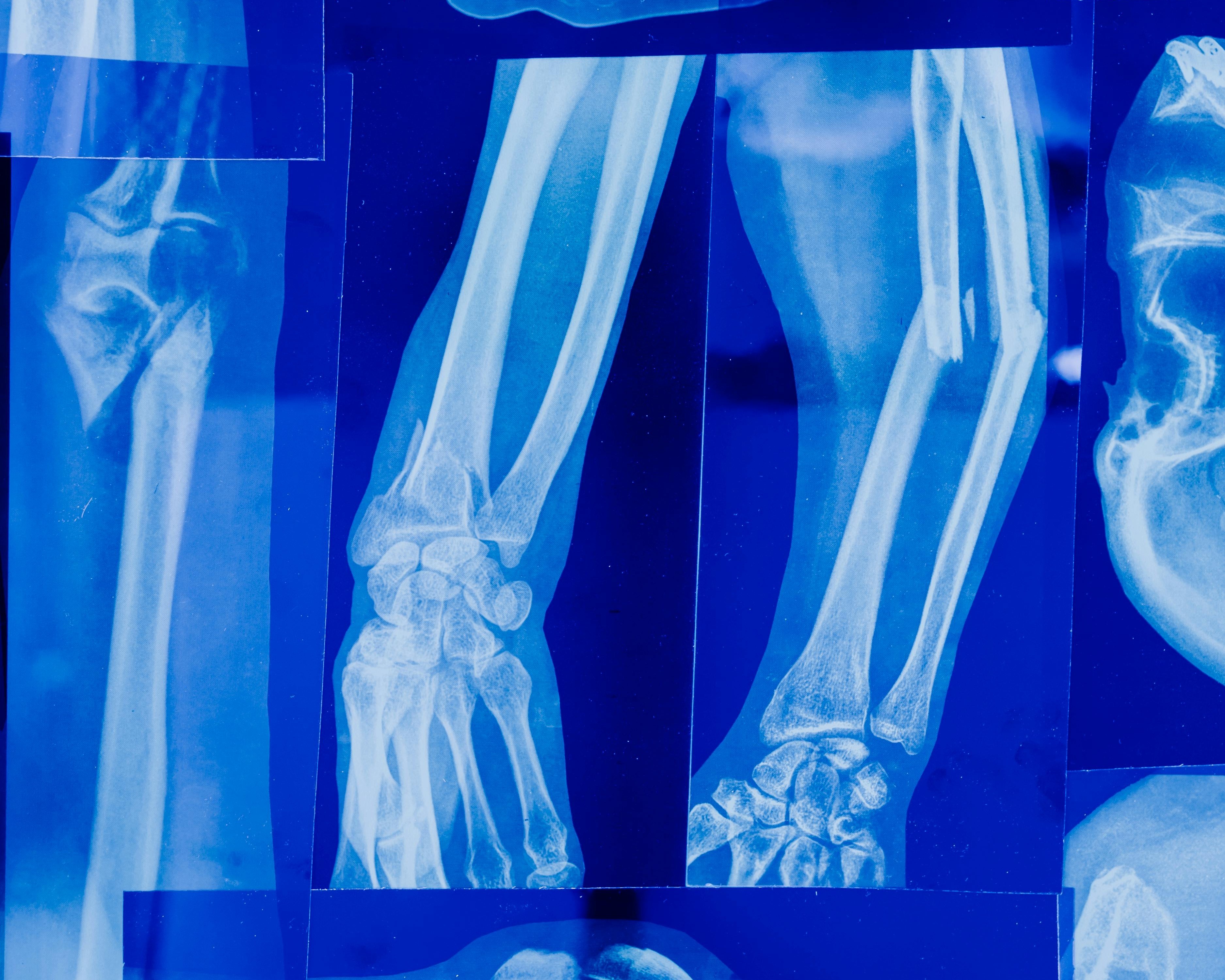 Osteopenia: por que essa condição que enfraquece os ossos costuma ser descoberta só depois de uma fratura