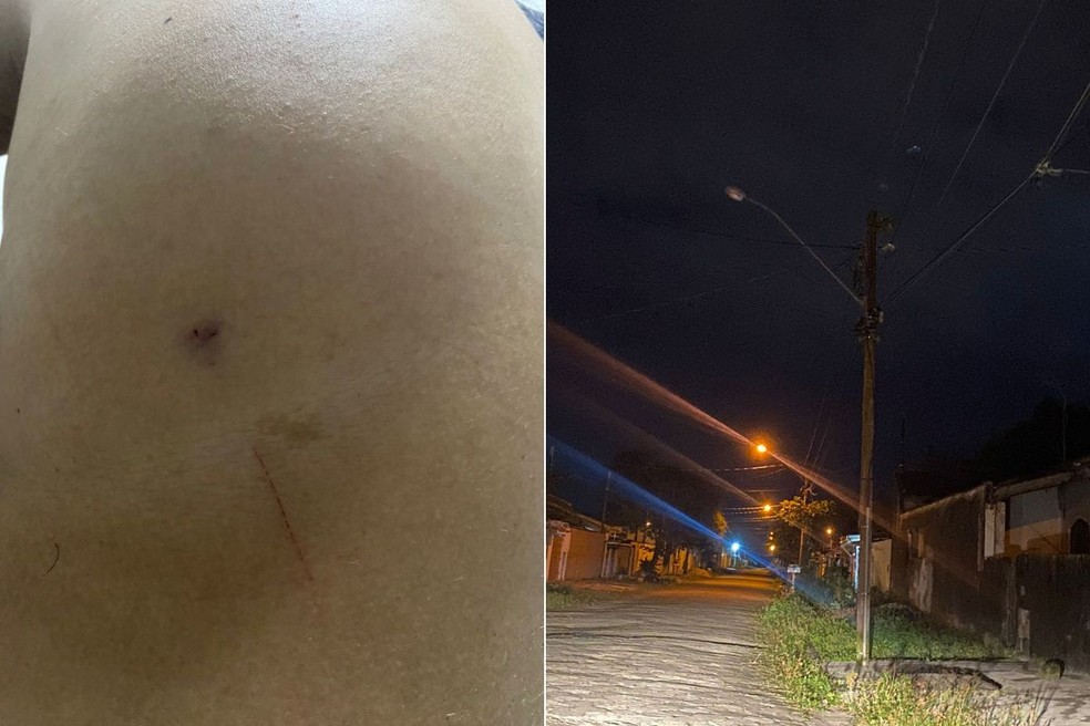 Mulher ficou com marcas no corpo após o criminoso tê-la abordado com um facão no bairro Savoy, em Itanhaém (SP). — Foto: Arquivo Pessoal