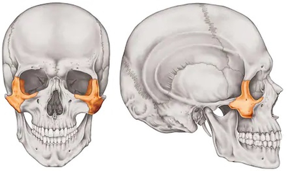 Homem quebrou osso zigomático — Foto: Reprodução