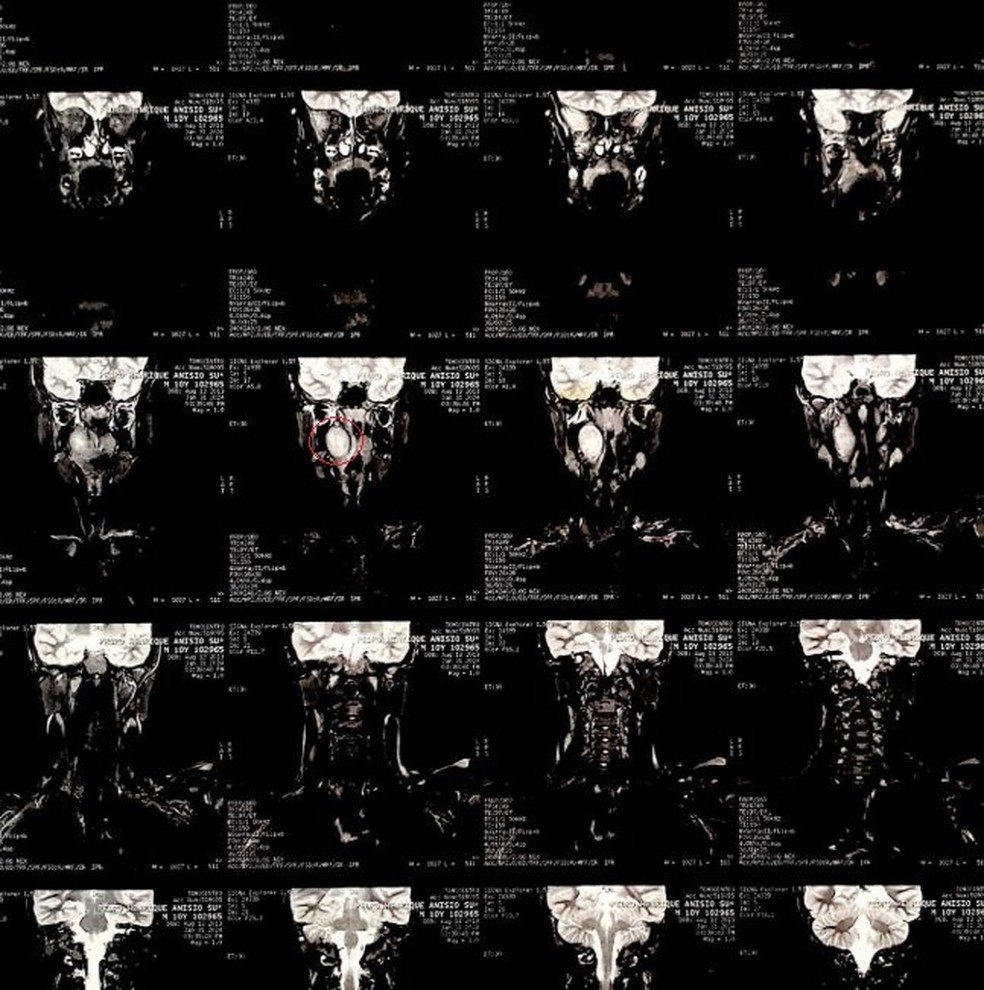 Tumor foi identificado em um exame de tomografia computadorizada — Foto: Arquivo pessoal