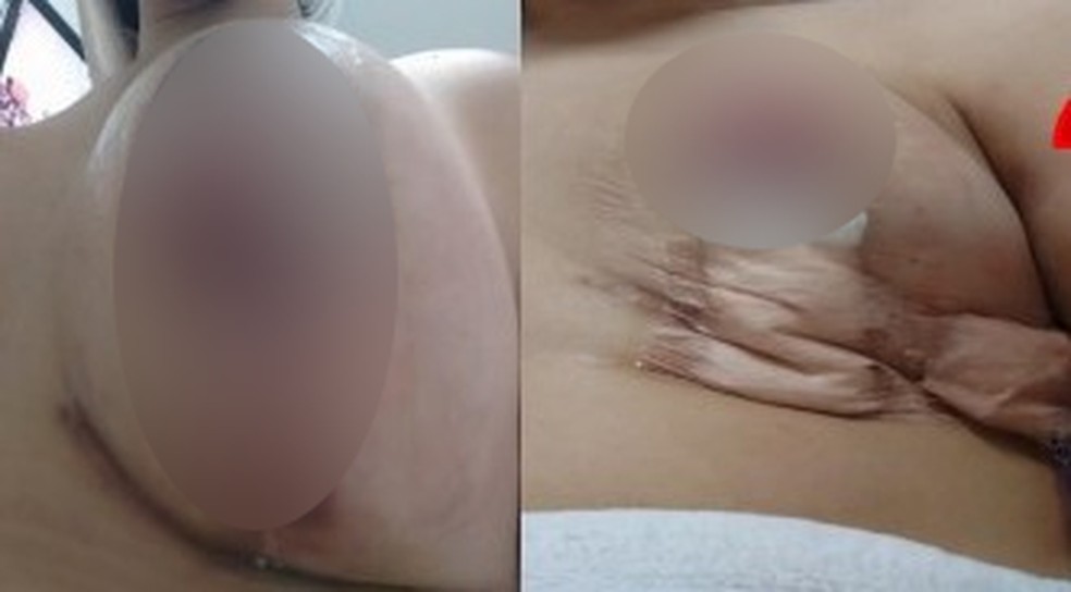 A cirurgia causou uma imperfeição grave na aréola do seio direito — Foto: Reprodução