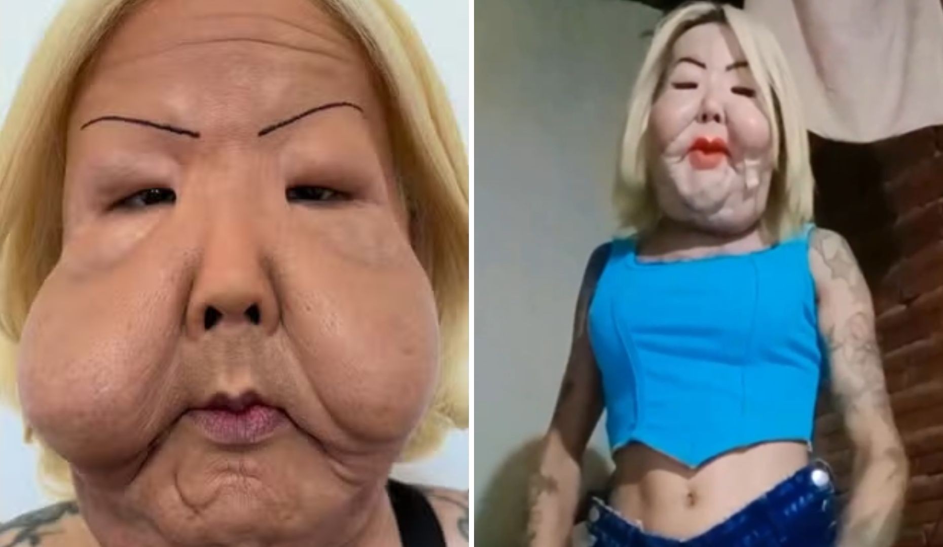 Juju do Pix mostra como está seu rosto 50 dias após cirurgia para retirar óleo mineral; veja antes e depois