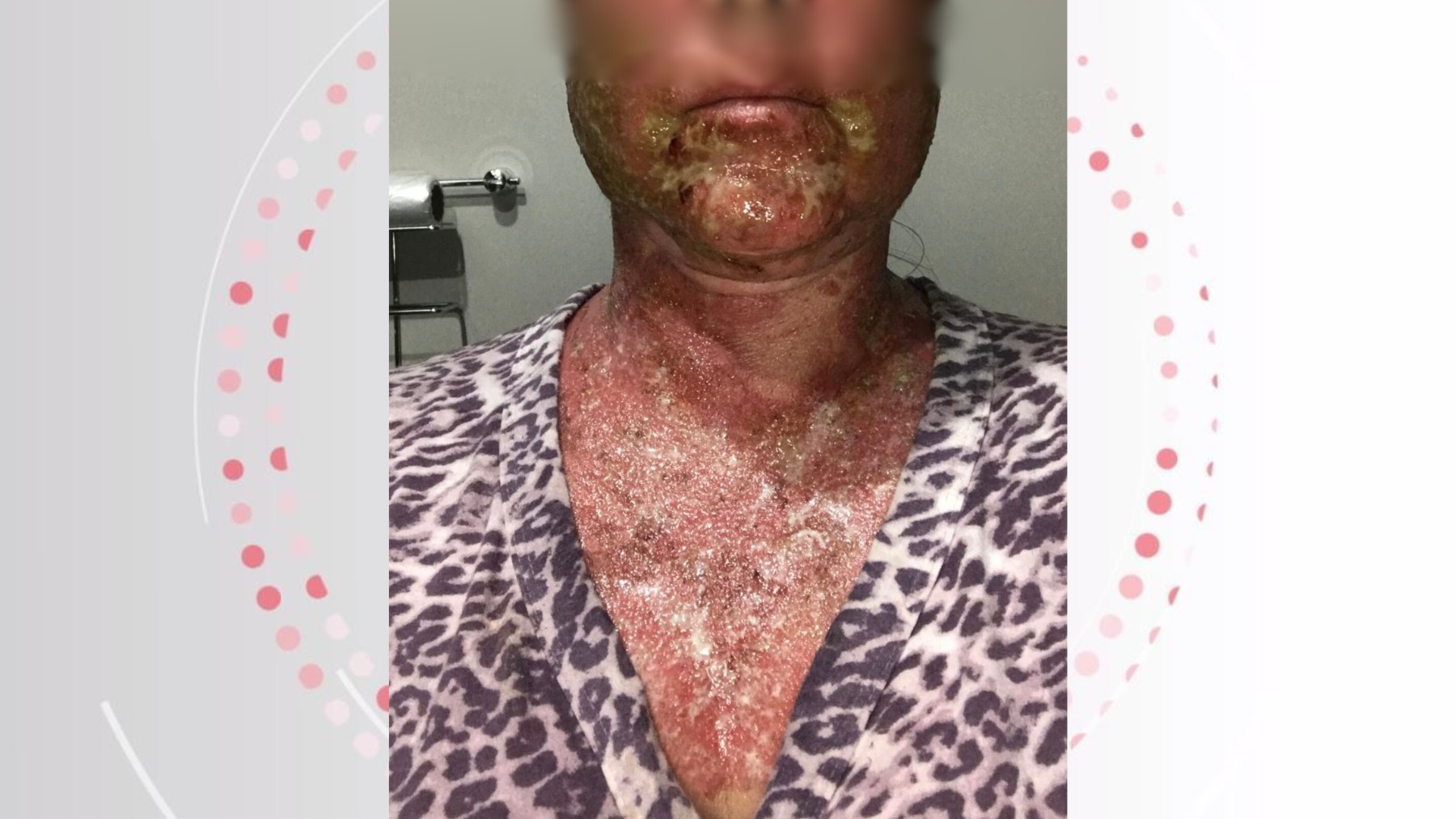 Farmacêutico e clínica que causaram queimaduras em mulher após peeling são condenados a pagar R$ 125 mil de indenização