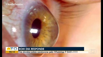 Bom Dia responde dúvidas dos telespectadores sobre ceratocone