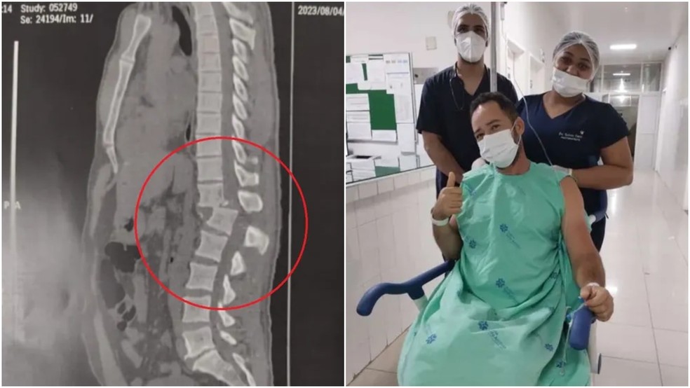 Raio-x mostra lesão na coluna de jovem lesão de jovem atingido por aparelho em academia de ginástica no Ceará — Foto: Arquivo pessoal