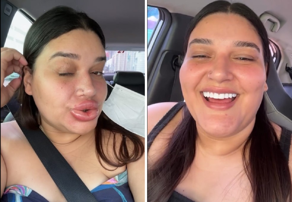 Montagem mostra antes e depois da maquiadora que teve inchaço após aplicação de enzima — Foto: Reprodução/Redes Sociais