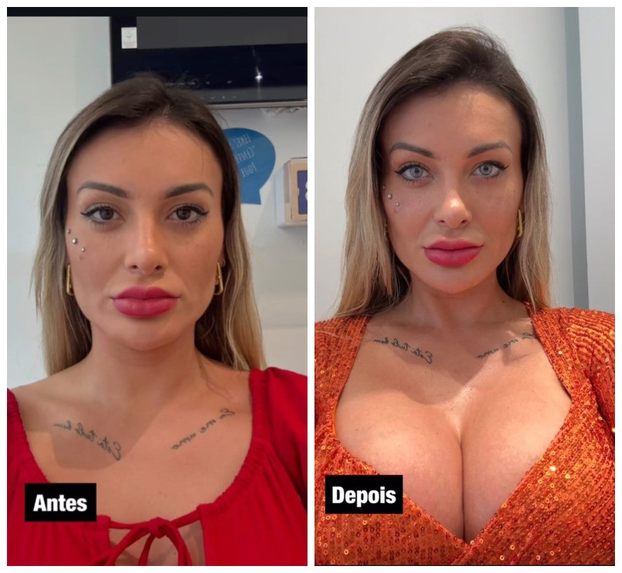 Andressa Urach relata dor e medo de ficar cega após cirurgia para mudar cor dos olhos; veja riscos do procedimento