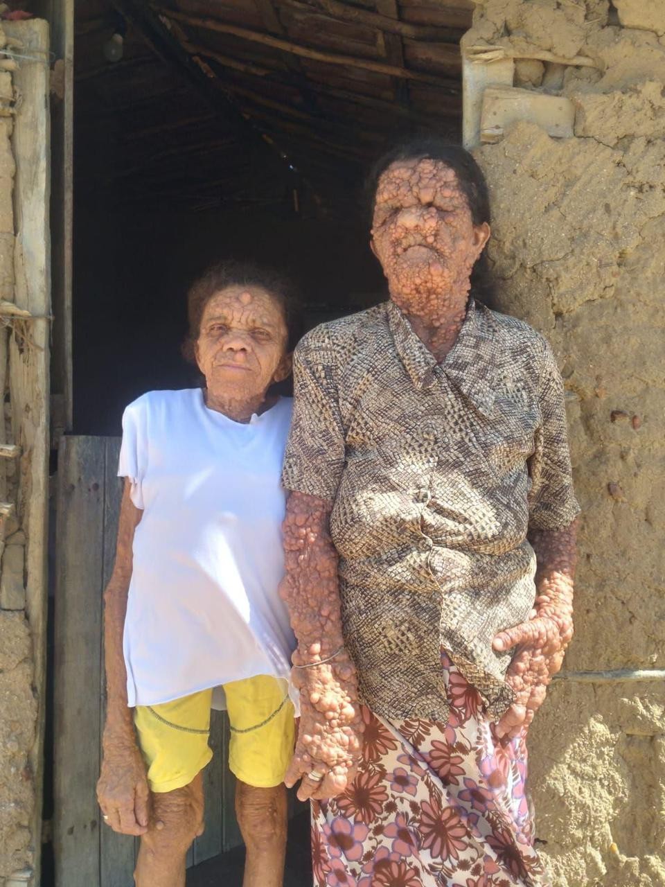 Neurofibromatose: mãe e filha na Paraíba convivem com doença rara que atravessa gerações: 'O povo se afasta da gente, mas entrego na mão de Deus’
