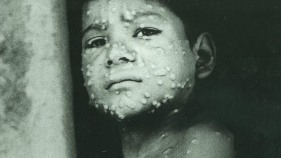 Erradicação só foi alcançada com a varíola em 1980 — Foto: Getty Images via BBC
