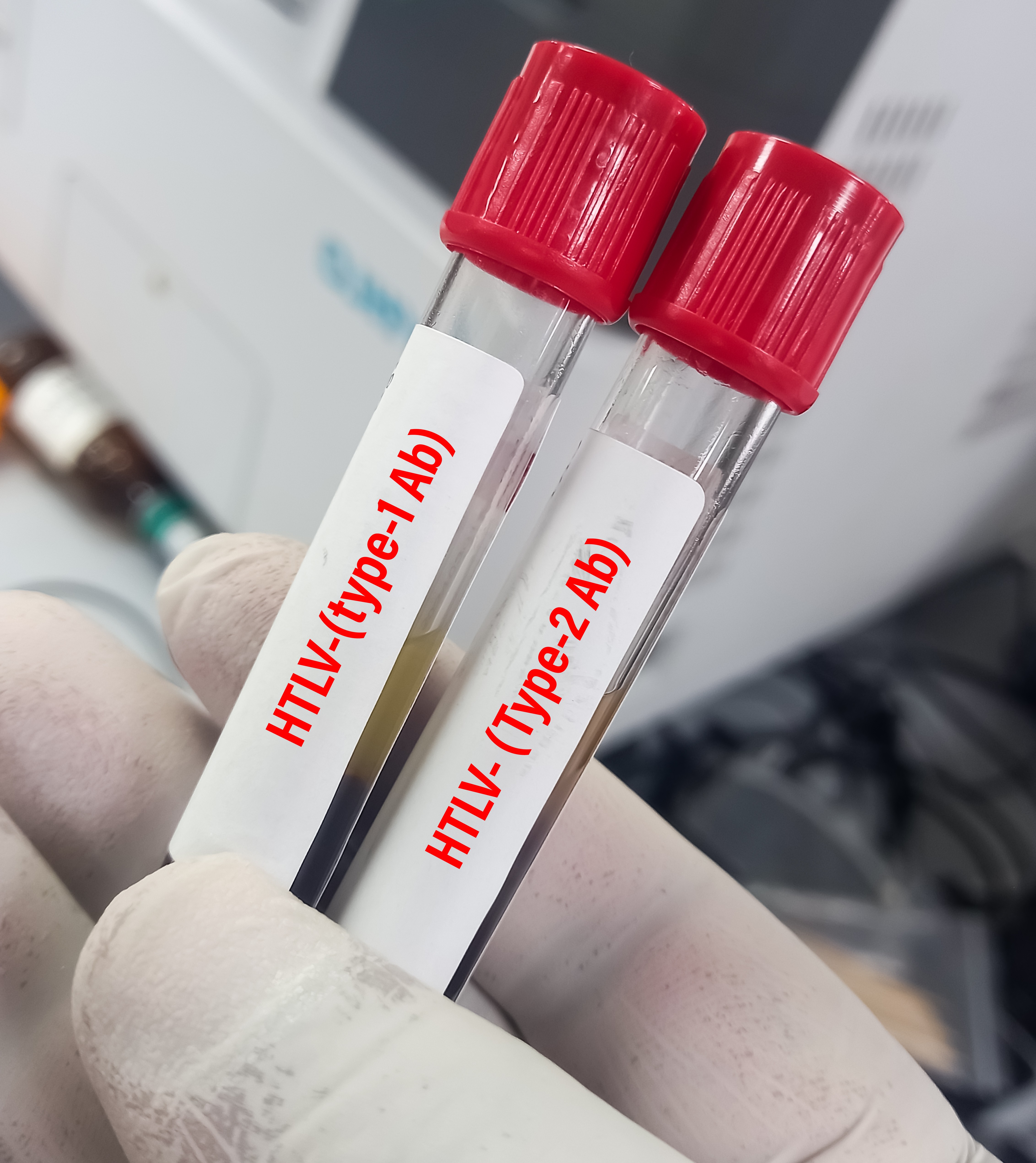 Estudo brasileiro usa retrovírus HTLV-1 para investigar avanço da esclerose múltipla progressiva