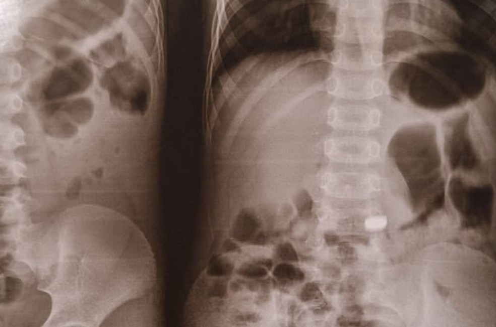 Pilha precisou ser retirada por endoscopia pelo risco de aderir à parede do intestino — Foto: Arquivo pessoal