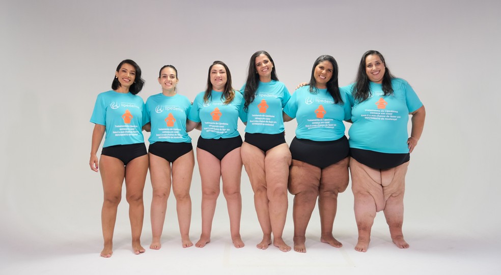 Mulheres com diversos graus de lipedema — Foto: ONG Movimento Lipedema