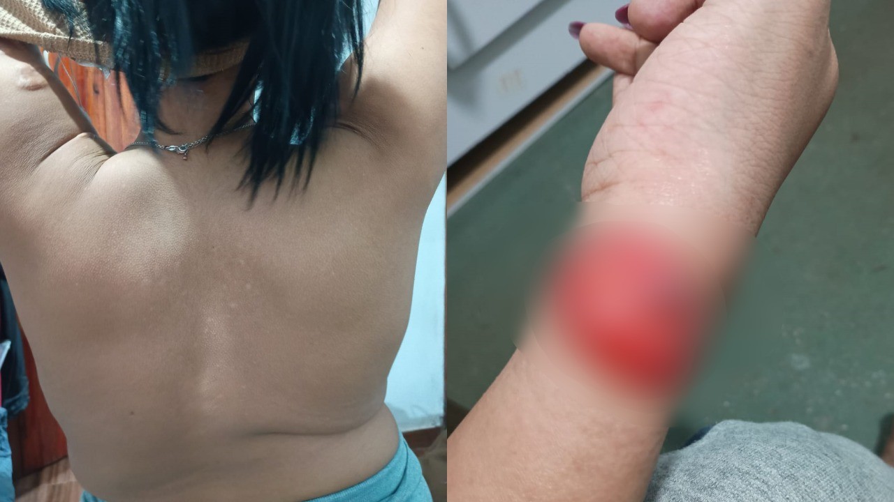 'Pele de seda' que rasga fácil e coluna em 'S': adolescente trata síndrome genética rara sem cura no único ambulatório que atende ao SUS no país